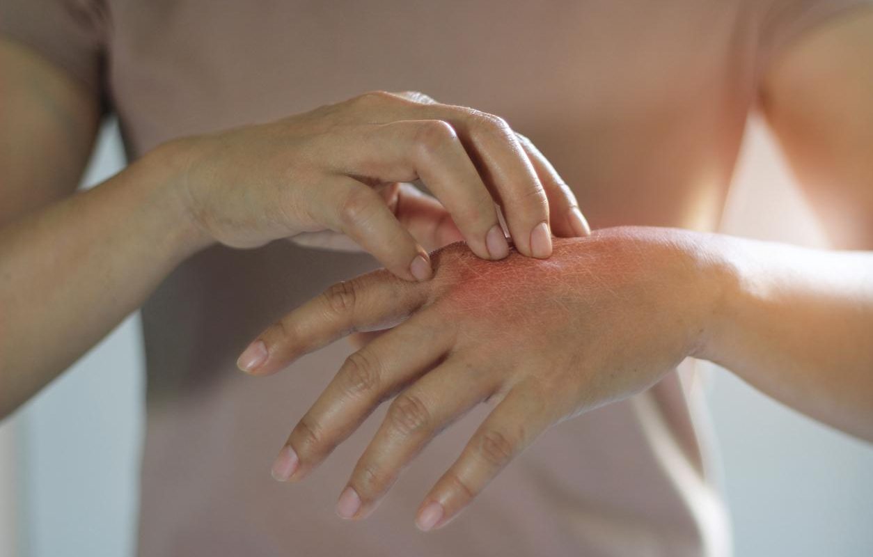 皮膚搔抓症：定義、病因、症狀和治療