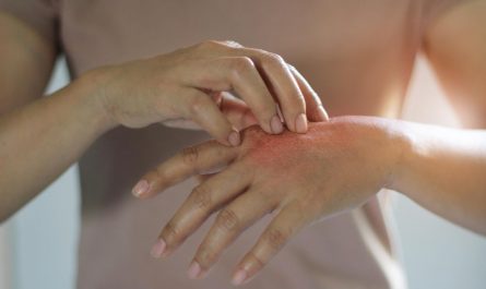 皮膚搔抓症：定義、病因、症狀和治療